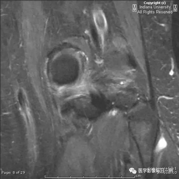 【病例】腓神经腱鞘囊肿1例MR影像表现 【病例】腓神经腱鞘囊肿1例MR影像表现