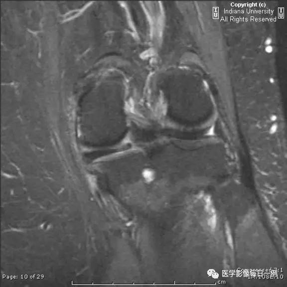 【病例】腓神经腱鞘囊肿1例MR影像表现 【病例】腓神经腱鞘囊肿1例MR影像表现
