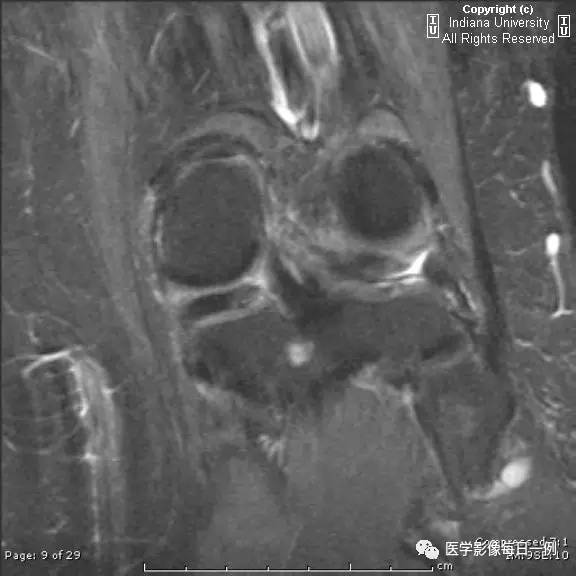 【病例】腓神经腱鞘囊肿1例MR影像表现 【病例】腓神经腱鞘囊肿1例MR影像表现