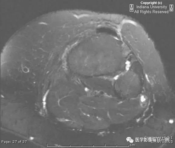 【病例】腓神经腱鞘囊肿1例MR影像表现 【病例】腓神经腱鞘囊肿1例MR影像表现