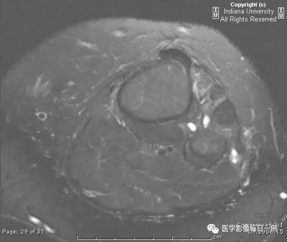 【病例】腓神经腱鞘囊肿1例MR影像表现 【病例】腓神经腱鞘囊肿1例MR影像表现