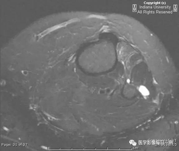 【病例】腓神经腱鞘囊肿1例MR影像表现 【病例】腓神经腱鞘囊肿1例MR影像表现