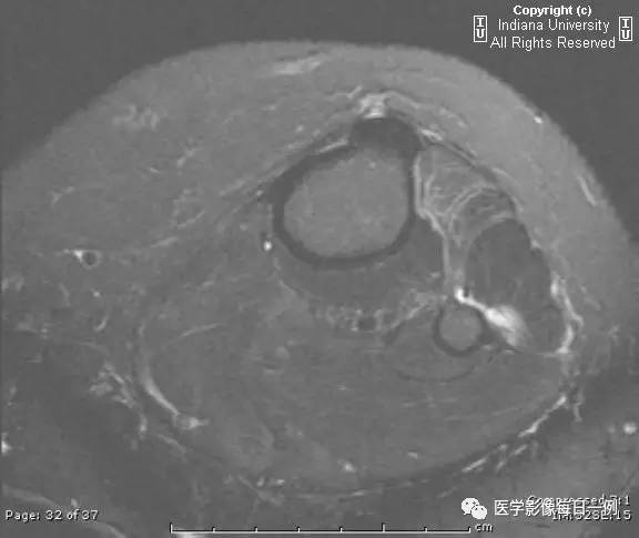 【病例】腓神经腱鞘囊肿1例MR影像表现 【病例】腓神经腱鞘囊肿1例MR影像表现