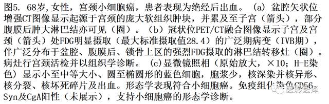 肺外小细胞癌：影像学特点及影像病理对照