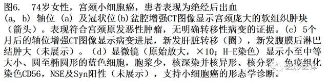 肺外小细胞癌：影像学特点及影像病理对照