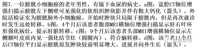肺外小细胞癌：影像学特点及影像病理对照