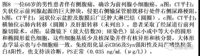 肺外小细胞癌：影像学特点及影像病理对照