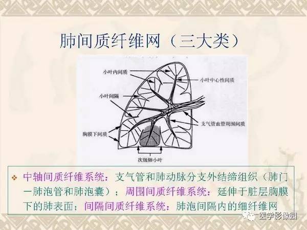 【PPT】急性间质性肺炎