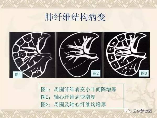 【PPT】急性间质性肺炎