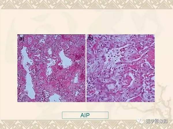 【PPT】急性间质性肺炎
