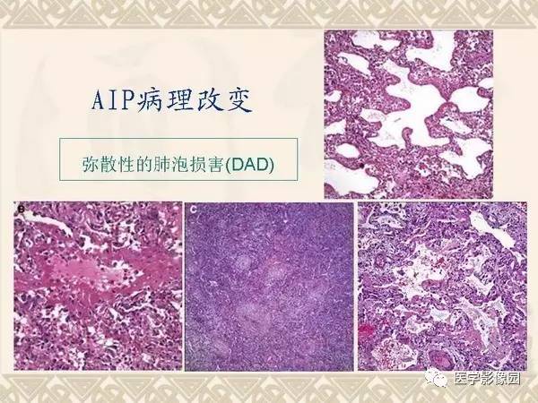 【PPT】急性间质性肺炎