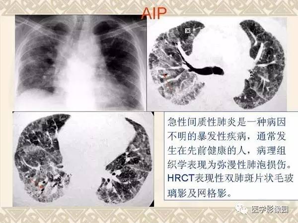 【PPT】急性间质性肺炎