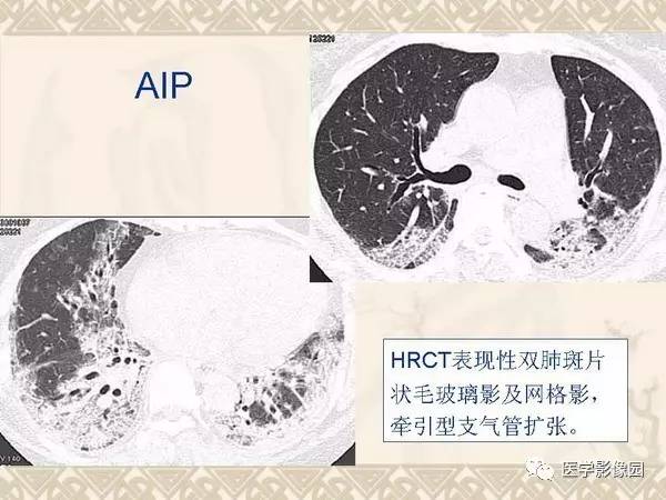 【PPT】急性间质性肺炎