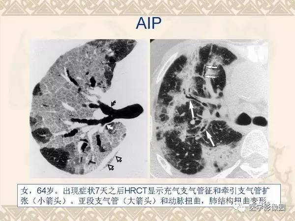 【PPT】急性间质性肺炎