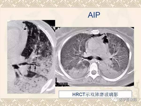 【PPT】急性间质性肺炎
