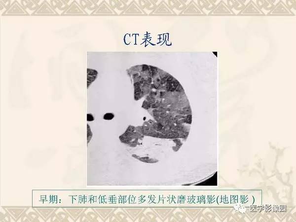 【PPT】急性间质性肺炎