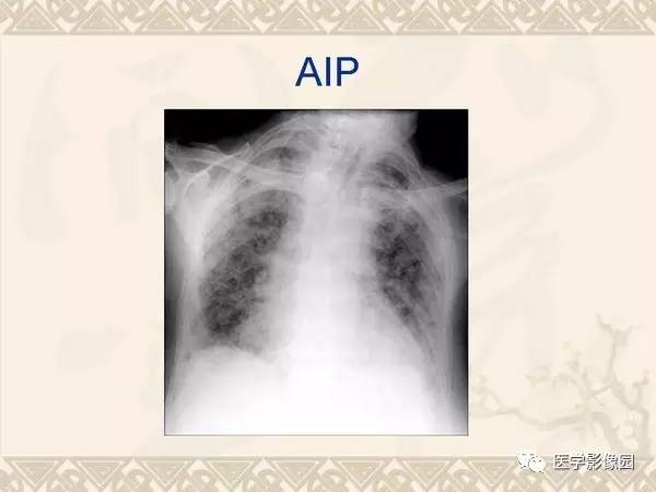 【PPT】急性间质性肺炎