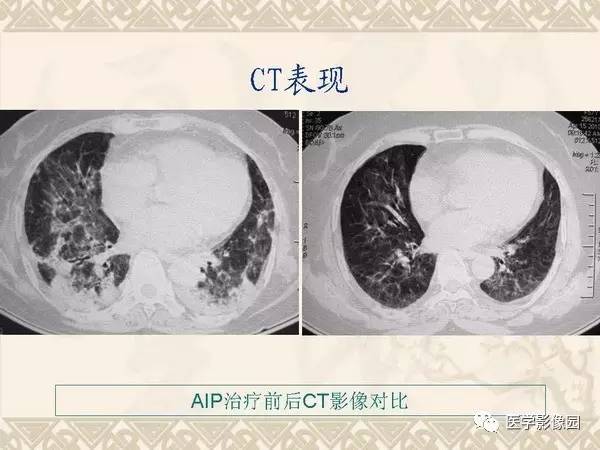 【PPT】急性间质性肺炎