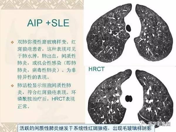 【PPT】急性间质性肺炎