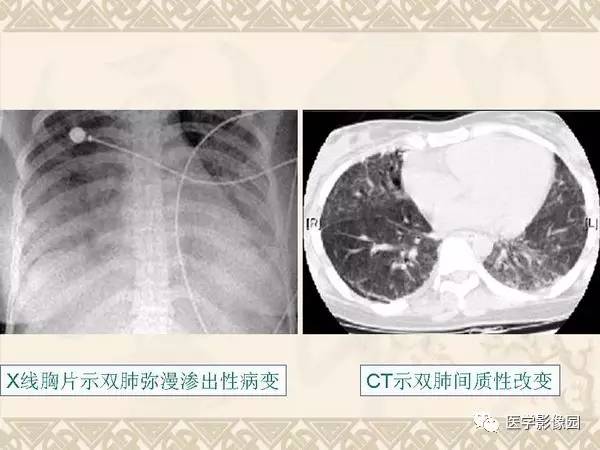 【PPT】急性间质性肺炎