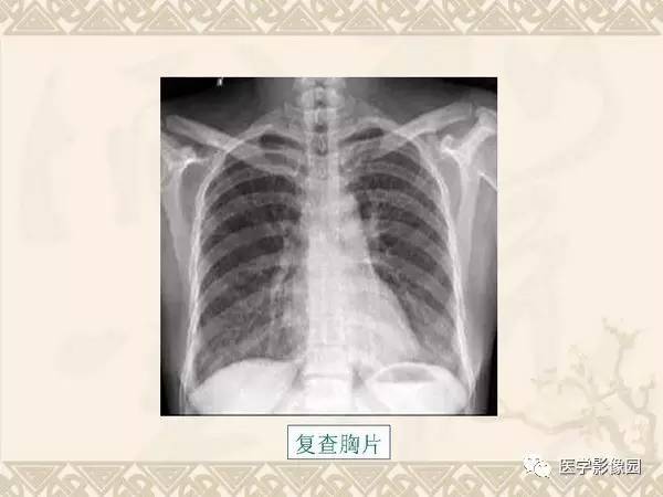 【PPT】急性间质性肺炎