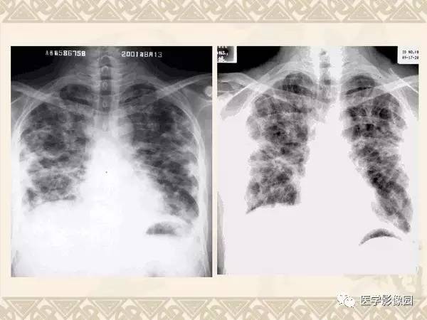 【PPT】急性间质性肺炎