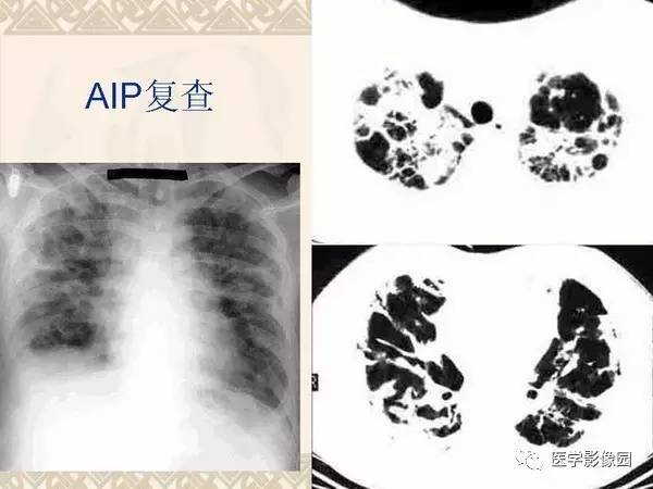 【PPT】急性间质性肺炎