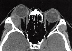 【病例】泪腺癌1例CT影像表现分析 【病例】泪腺癌1例CT影像表现分析