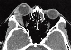 【病例】泪腺癌1例CT影像表现分析 【病例】泪腺癌1例CT影像表现分析