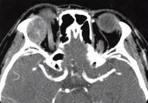 【病例】泪腺癌1例CT影像表现分析 【病例】泪腺癌1例CT影像表现分析
