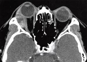 【病例】泪腺癌1例CT影像表现分析 【病例】泪腺癌1例CT影像表现分析