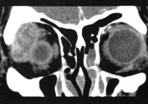 【病例】泪腺癌1例CT影像表现分析 【病例】泪腺癌1例CT影像表现分析