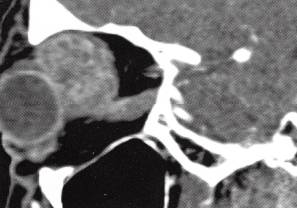 【病例】泪腺癌1例CT影像表现分析 【病例】泪腺癌1例CT影像表现分析