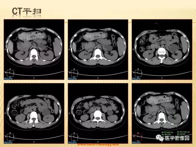 【病例】肾上腺区囊实性肿瘤——神经鞘瘤1例CT及MR 【病例】肾上腺区囊实性肿瘤——神经鞘瘤1例CT及MR