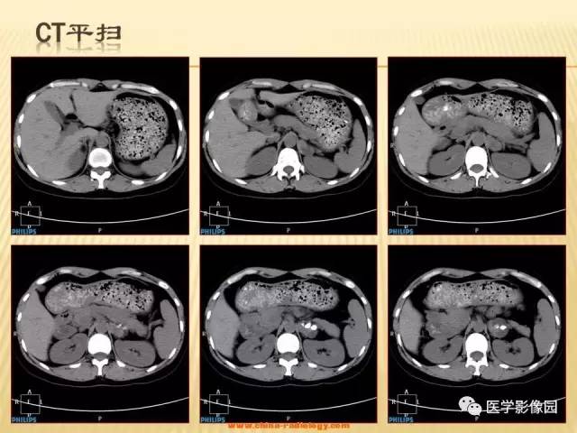 【病例】肾上腺区囊实性肿瘤——神经鞘瘤1例CT及MR 【病例】肾上腺区囊实性肿瘤——神经鞘瘤1例CT及MR