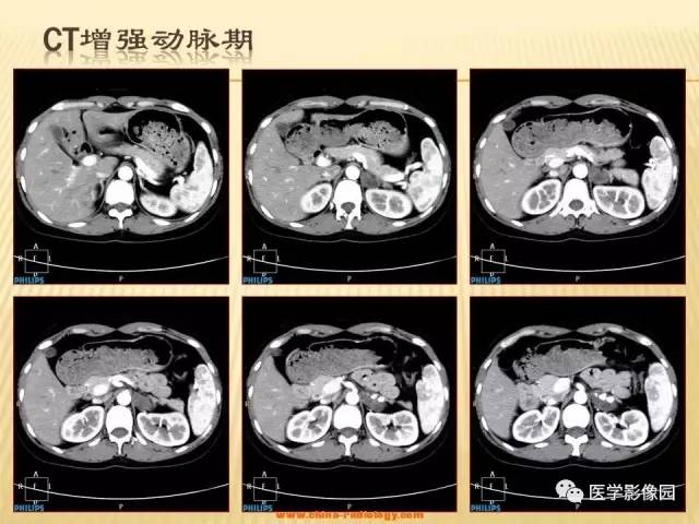 【病例】肾上腺区囊实性肿瘤——神经鞘瘤1例CT及MR 【病例】肾上腺区囊实性肿瘤——神经鞘瘤1例CT及MR