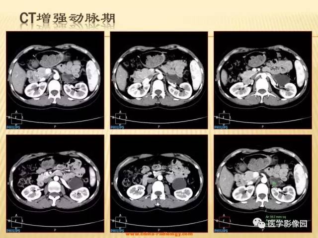 【病例】肾上腺区囊实性肿瘤——神经鞘瘤1例CT及MR 【病例】肾上腺区囊实性肿瘤——神经鞘瘤1例CT及MR