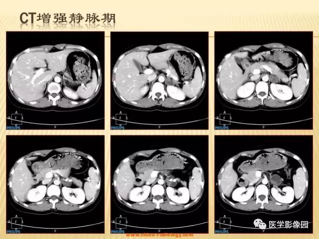 【病例】肾上腺区囊实性肿瘤——神经鞘瘤1例CT及MR 【病例】肾上腺区囊实性肿瘤——神经鞘瘤1例CT及MR
