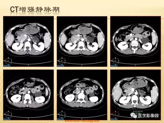 【病例】肾上腺区囊实性肿瘤——神经鞘瘤1例CT及MR 【病例】肾上腺区囊实性肿瘤——神经鞘瘤1例CT及MR
