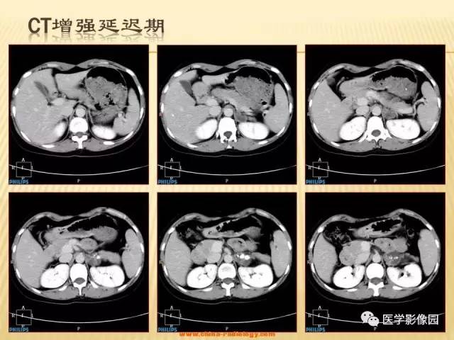 【病例】肾上腺区囊实性肿瘤——神经鞘瘤1例CT及MR 【病例】肾上腺区囊实性肿瘤——神经鞘瘤1例CT及MR