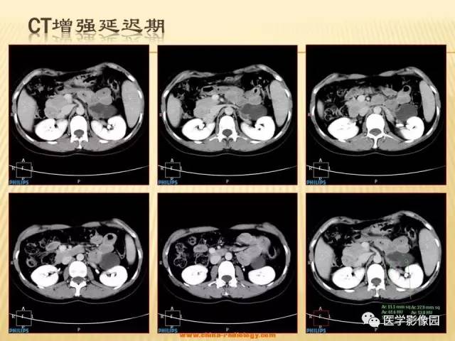 【病例】肾上腺区囊实性肿瘤——神经鞘瘤1例CT及MR 【病例】肾上腺区囊实性肿瘤——神经鞘瘤1例CT及MR