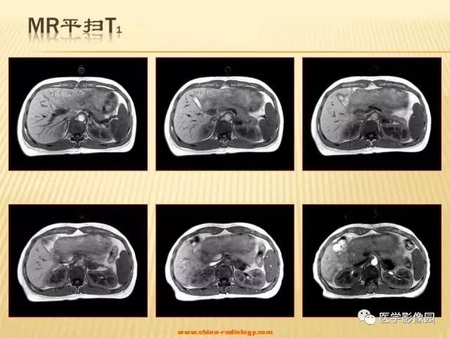 【病例】肾上腺区囊实性肿瘤——神经鞘瘤1例CT及MR 【病例】肾上腺区囊实性肿瘤——神经鞘瘤1例CT及MR