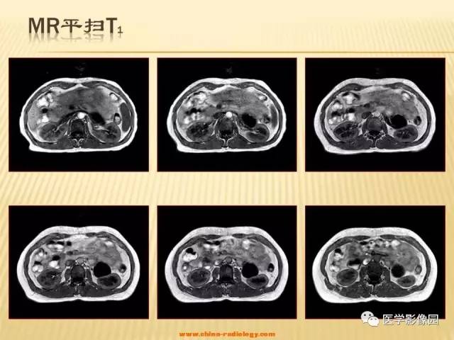 【病例】肾上腺区囊实性肿瘤——神经鞘瘤1例CT及MR 【病例】肾上腺区囊实性肿瘤——神经鞘瘤1例CT及MR