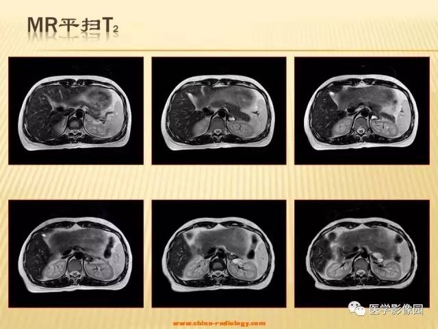 【病例】肾上腺区囊实性肿瘤——神经鞘瘤1例CT及MR 【病例】肾上腺区囊实性肿瘤——神经鞘瘤1例CT及MR