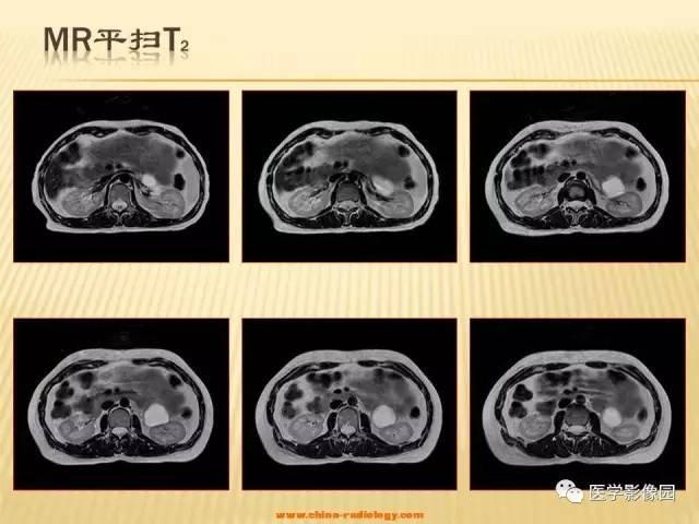 【病例】肾上腺区囊实性肿瘤——神经鞘瘤1例CT及MR 【病例】肾上腺区囊实性肿瘤——神经鞘瘤1例CT及MR