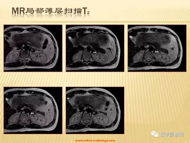 【病例】肾上腺区囊实性肿瘤——神经鞘瘤1例CT及MR 【病例】肾上腺区囊实性肿瘤——神经鞘瘤1例CT及MR