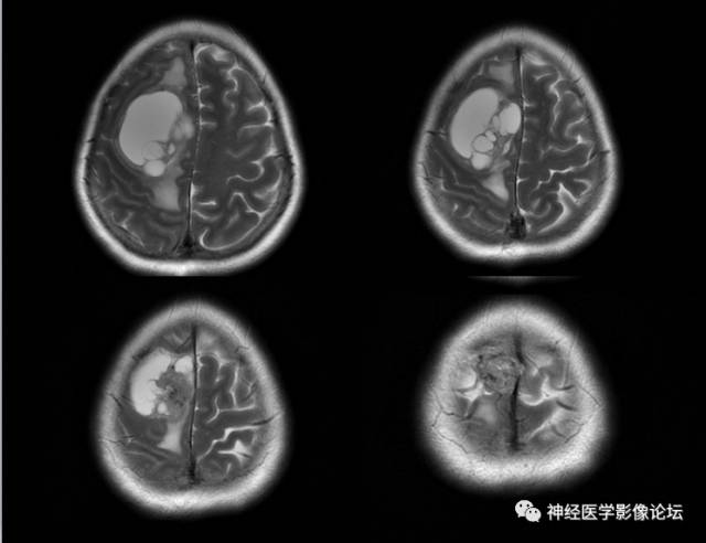【病例】囊性(纤维型)脑膜瘤一例MR影像表现