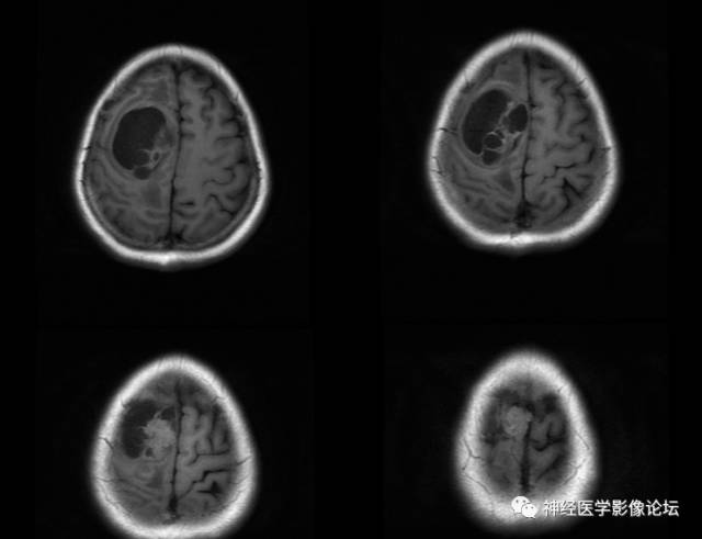 【病例】囊性(纤维型)脑膜瘤一例MR影像表现