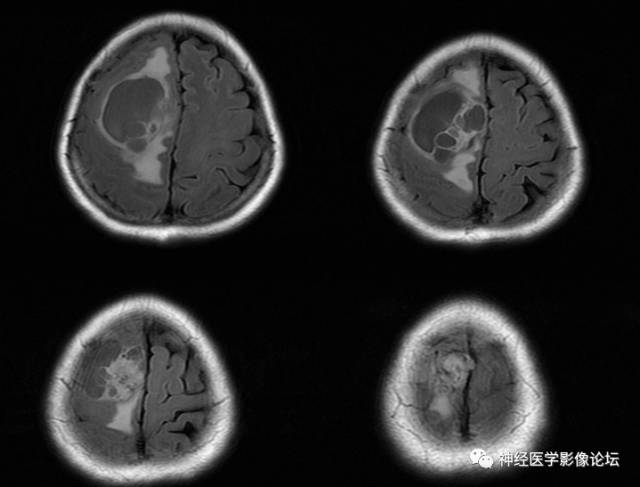 【病例】囊性(纤维型)脑膜瘤一例MR影像表现