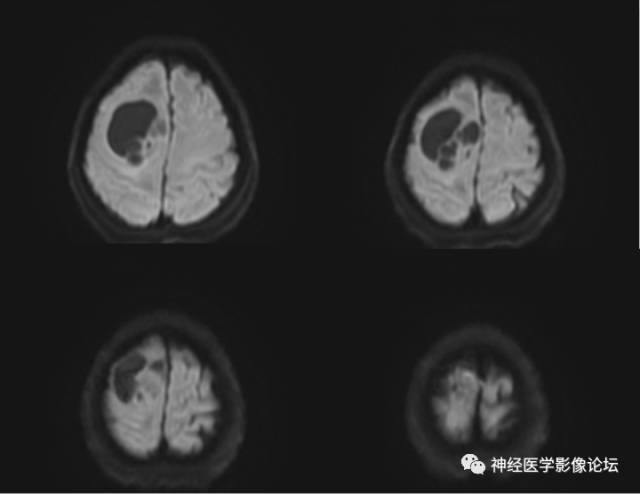 【病例】囊性(纤维型)脑膜瘤一例MR影像表现